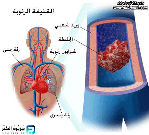 القذائف الرئوية .. فيديو وصور حية