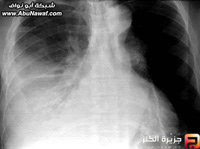 القذائف الرئوية .. فيديو وصور حية