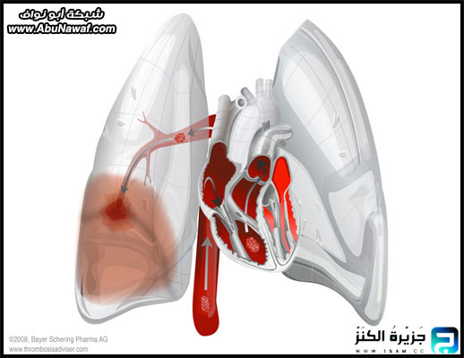 القذائف الرئوية .. فيديو وصور حية