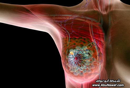الدليل المصور لسرطان الثدي