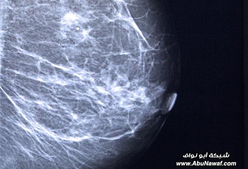 الدليل المصور لسرطان الثدي الدليل