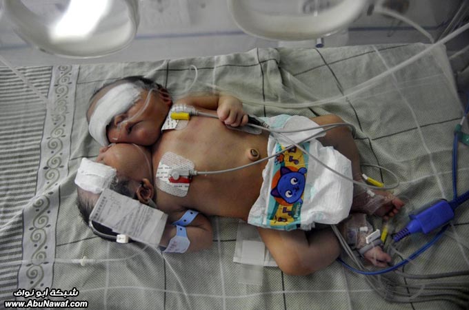 صور حول العالم: كابول فرايد تشيكن + حالة نادرة لطفل برأسين .. والمزيد